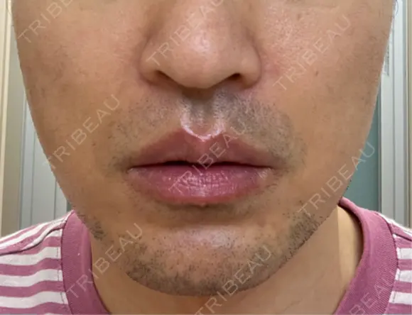 RF（高周波）たるみ治療 湘南美容クリニック 大阪梅田本院 DAY 6 メイン用