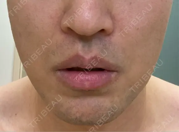 RF（高周波）たるみ治療 湘南美容クリニック 大阪梅田本院 DAY 7 メイン用