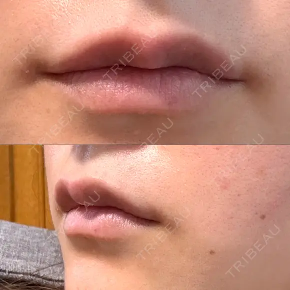 ヒアルロン酸注入（唇） / ボトックス（口角） ルラ美容クリニック 大阪心斎橋院 DAY 1 メイン用