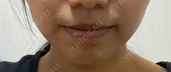 RF（高周波）たるみ治療 Wing clinic 豊中駅前院 AFTER メイン用