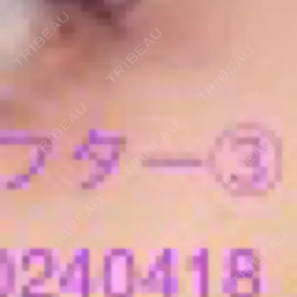 ボトックス（タレ目） / ボトックス（目尻） 品川美容外科 新宿院（※品川スキンクリニック提携） DAY 2 メイン用