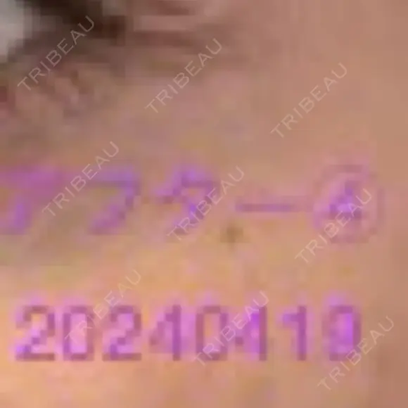 ボトックス（タレ目） / ボトックス（目尻） 品川美容外科 新宿院（※品川スキンクリニック提携） DAY 3 メイン用