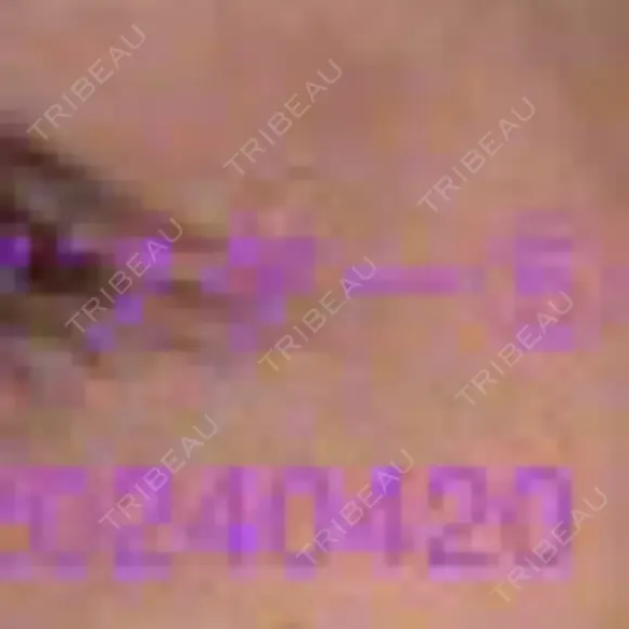 ボトックス（タレ目） / ボトックス（目尻） 品川美容外科 新宿院（※品川スキンクリニック提携） DAY 4 メイン用