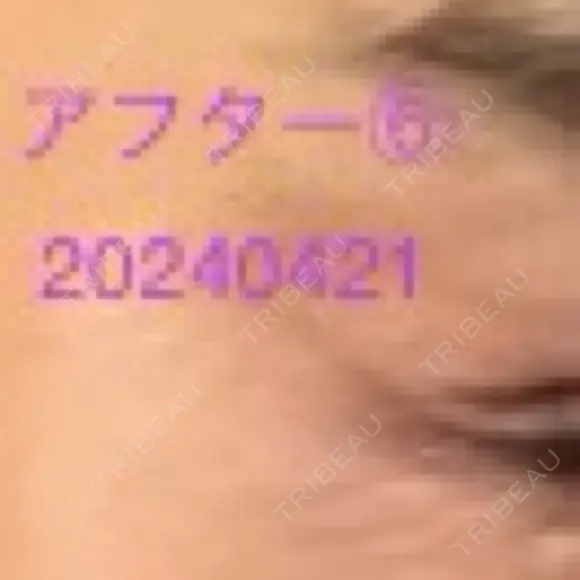 ボトックス（タレ目） / ボトックス（目尻） 品川美容外科 新宿院（※品川スキンクリニック提携） DAY 5 メイン用