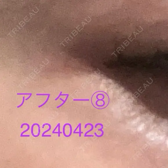 ボトックス（タレ目） / ボトックス（目尻） 品川美容外科 新宿院（※品川スキンクリニック提携） DAY 7 メイン用