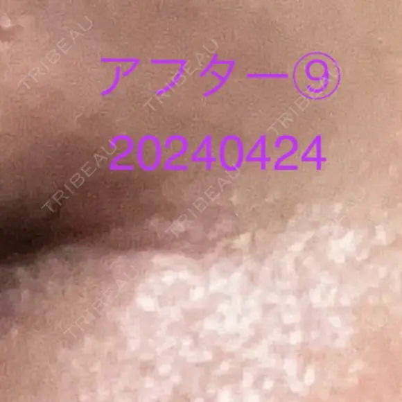 ボトックス（タレ目） / ボトックス（目尻） 品川美容外科 新宿院（※品川スキンクリニック提携） DAY 8 メイン用