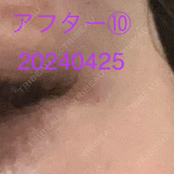 ボトックス（タレ目） / ボトックス（目尻） 品川美容外科 新宿院（※品川スキンクリニック提携） AFTER メイン用