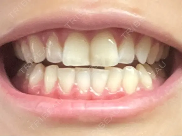 ホワイトニング 銀座本院 歯と美容のクリニック AFTER メイン用