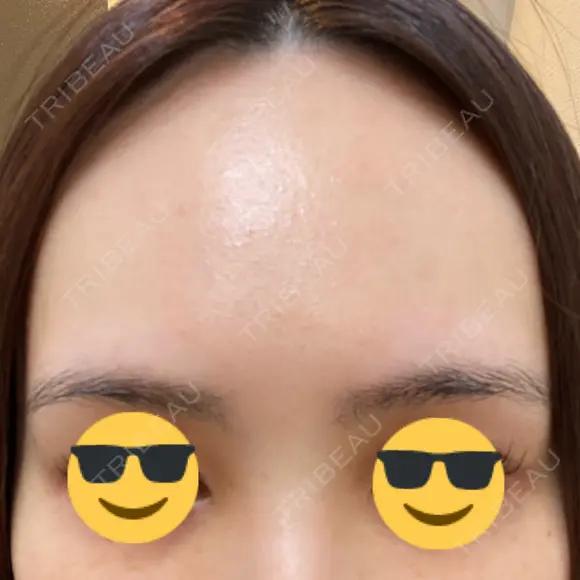 ピーリング（ハリ・ツヤ） FIG CLINIC AFTER メイン用