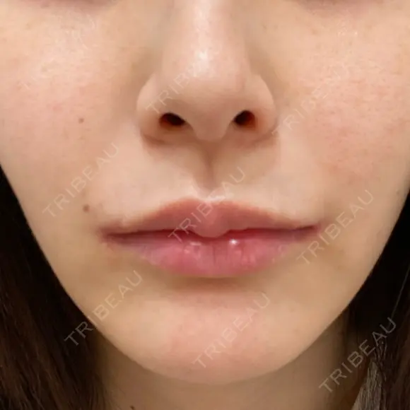 ピーリング（ハリ・ツヤ） FIG CLINIC DAY 4 メイン用