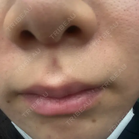 医療脱毛（顔） 新宿Ladies&Gentlemen美容クリニック AFTER メイン用
