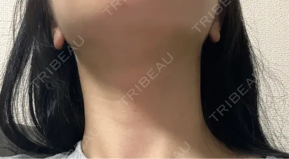 糸リフト / 脂肪吸引（顔） / ボトックス（エラ・小顔） A CLINIC（エークリニック） 新宿院 AFTER メイン用