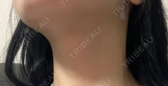 糸リフト / 脂肪吸引（顔） / ボトックス（エラ・小顔） A CLINIC（エークリニック） 新宿院 DAY 2 メイン用