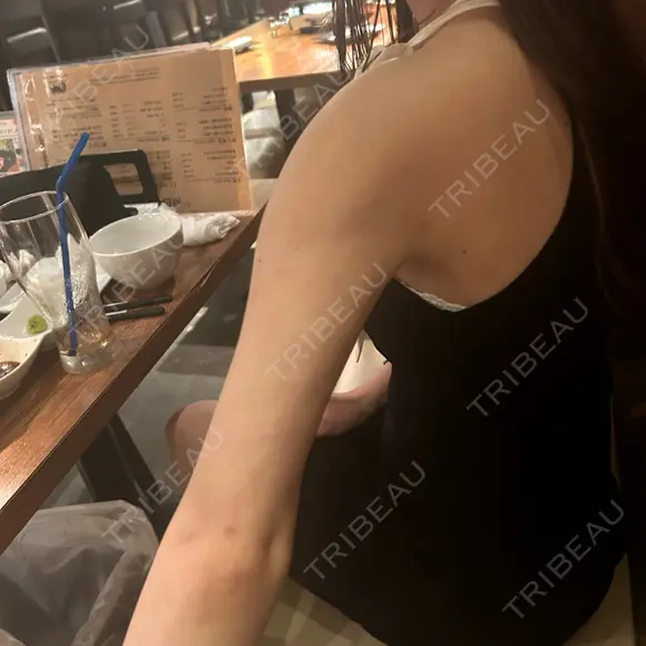 脂肪吸引（二の腕） アムルーズ美容外科クリニック 横浜院 DAY 410 メイン用