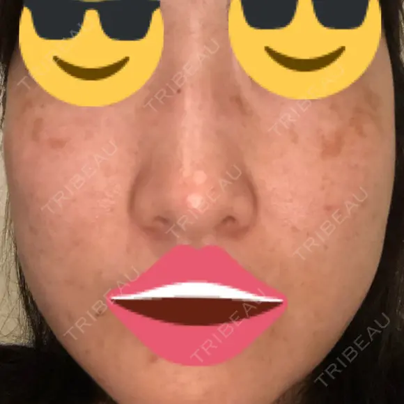 プラセンタ注射 / シミ取りレーザー 仁愛クリニック DAY 52 メイン用