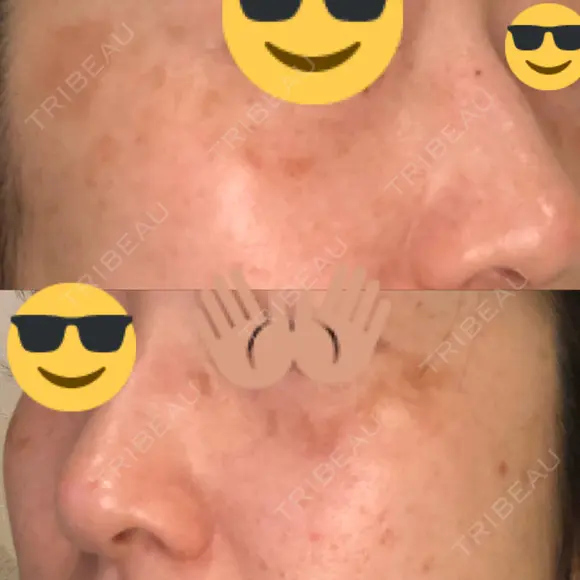 プラセンタ注射 / シミ取りレーザー 仁愛クリニック DAY 52 メイン用