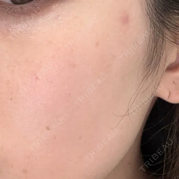 ルメッカ 東京美容外科 名古屋院 DAY 0 メイン用