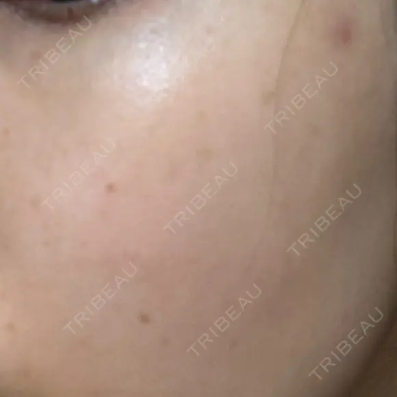 ルメッカ 東京美容外科 名古屋院 AFTER メイン用