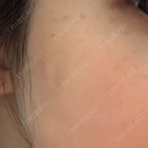 ルメッカ 東京美容外科 名古屋院 DAY 4 メイン用