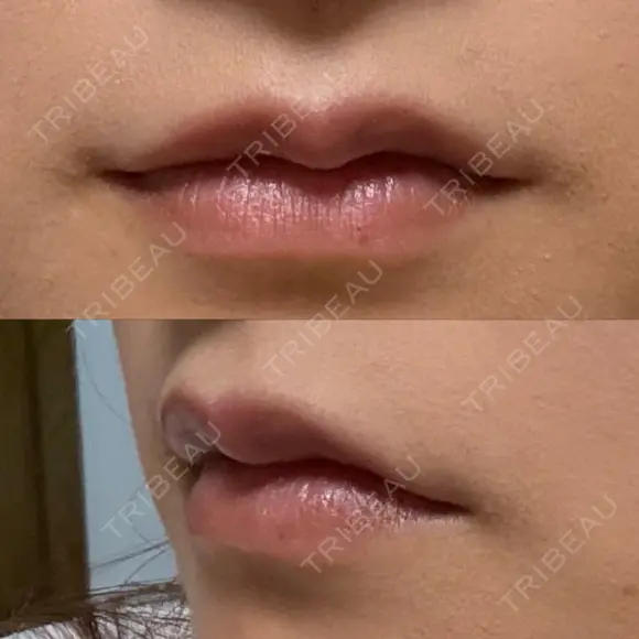 ヒアルロン酸注入（唇） / ボトックス（口角） ルラ美容クリニック 大阪心斎橋院 DAY 3 メイン用