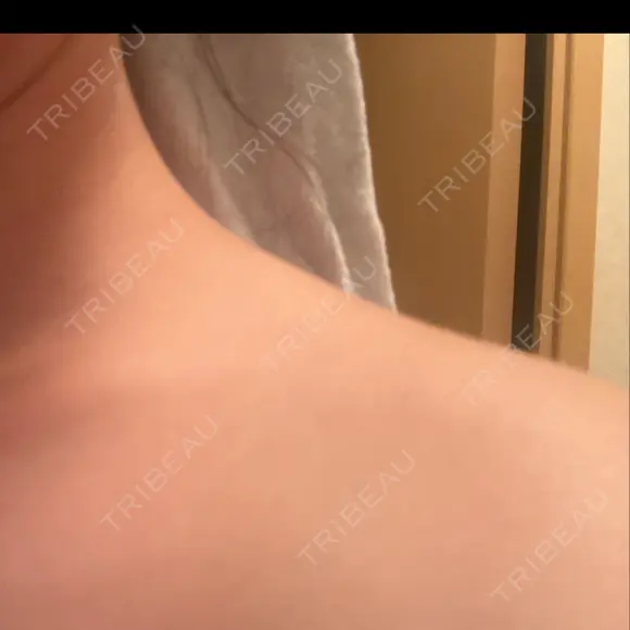 ボトックス（肩） / 高濃度ビタミンC点滴 小倉美容外科/美容皮膚科 ビラビューティークリニック DAY 3 メイン用