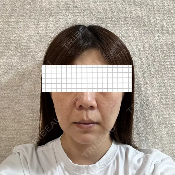 バッカルファット除去 アリエル美容クリニック 大宮院 DAY 14 メイン用