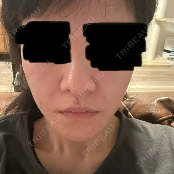 ボトックス（あご） / ボトックス（エラ・小顔） / ボトックス（口角） / ワキ汗治療（ボトックス） DMTC CLINIC 日本橋院 DAY 0 メイン用