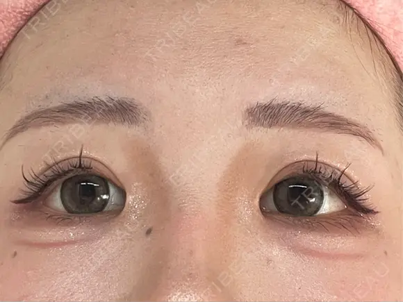 二重埋没 / 目頭切開 GRACIA clinic 【グラシアクリニック】 AFTER メイン用