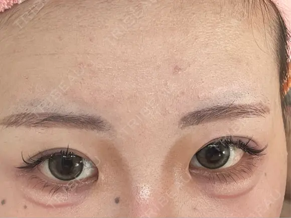 二重埋没 / 目頭切開 GRACIA clinic 【グラシアクリニック】 DAY 119 メイン用