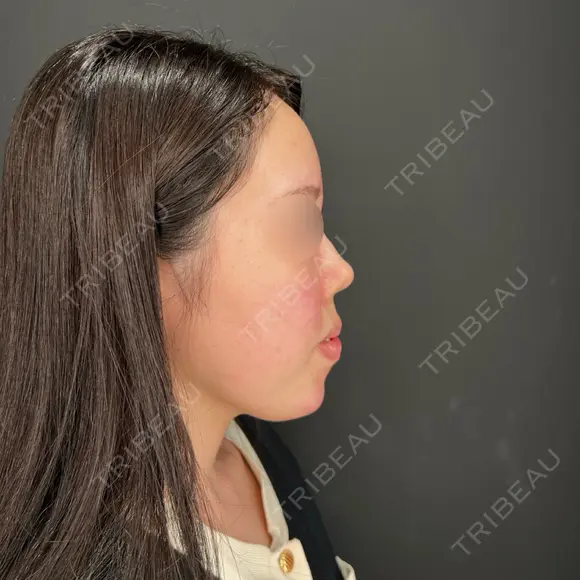 ボトックス（あご） / ヒアルロン酸注入（あご） / ボトックス（眉間） / ヒアルロン酸注入（鼻翼基部） HAAB×DREAM BEAUTY CLINIC 大阪梅田院 AFTER メイン用