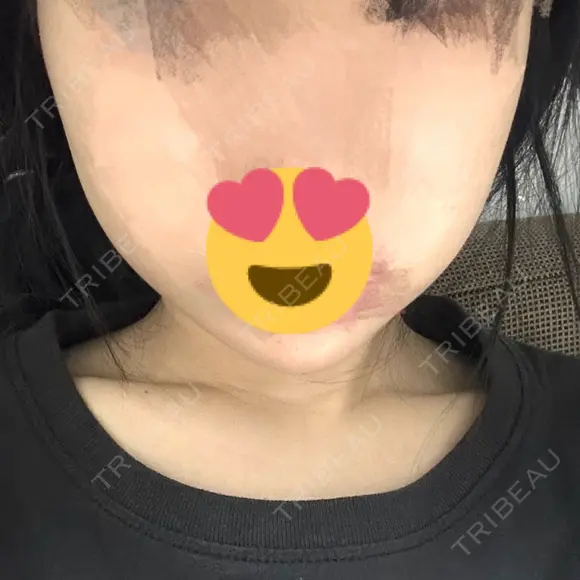 ボトックス（あご） / ヒアルロン酸注入（あご） / ボトックス（エラ・小顔） SUNMELIA SKIN CLINIC DAY 2 メイン用