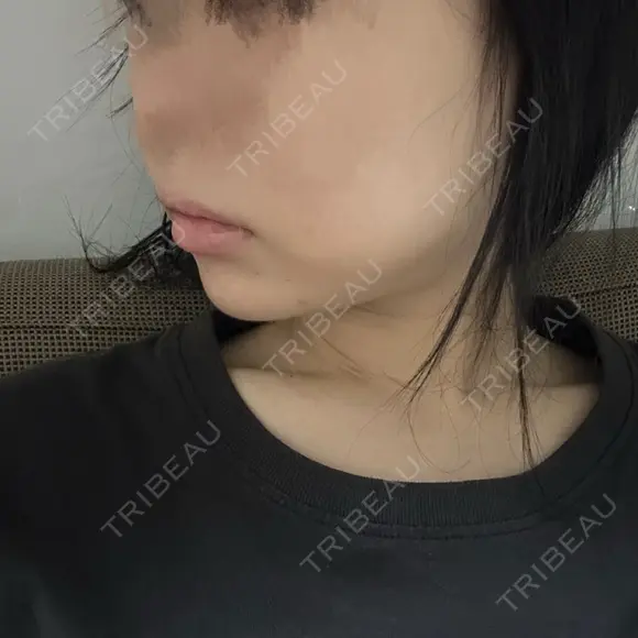 ボトックス（あご） / ヒアルロン酸注入（あご） / ボトックス（エラ・小顔） SUNMELIA SKIN CLINIC DAY 2 メイン用