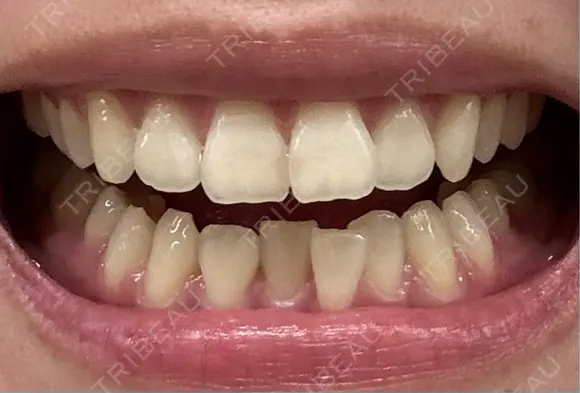 矯正（マウスピース） 湘南歯科クリニック 池袋院 DAY 0 メイン用