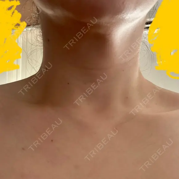 ボトックス（肩） 大美会クリニック 京都烏丸院 AFTER メイン用