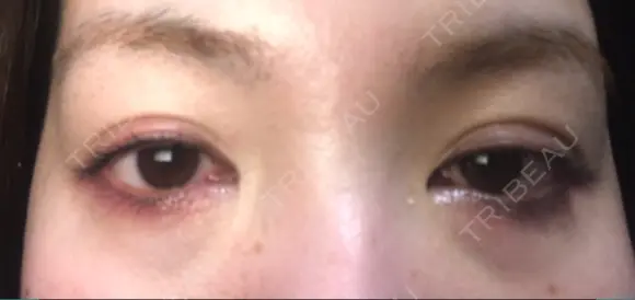 二重埋没 城本クリニック 大阪院 DAY 49 メイン用