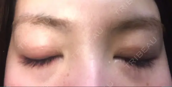 二重埋没 城本クリニック 大阪院 DAY 49 メイン用