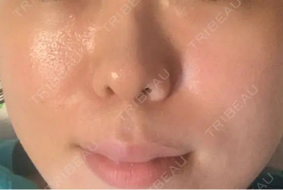 肌育注射（ジュベルックなど） / その他（肌） 新宿Ladies&Gentlemen美容クリニック AFTER メイン用