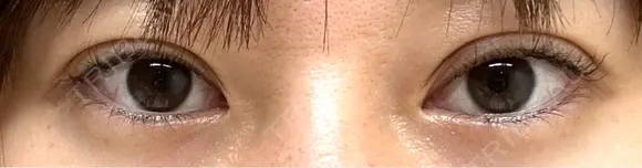 二重埋没 湘南美容クリニック 千葉センシティ院 DAY 21 メイン用