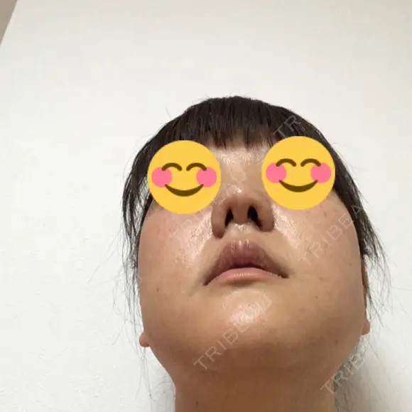 鼻尖形成（切開） / 小鼻縮小（切開） / 鼻尖縮小 湘南美容クリニック 神戸院 DAY 22 メイン用