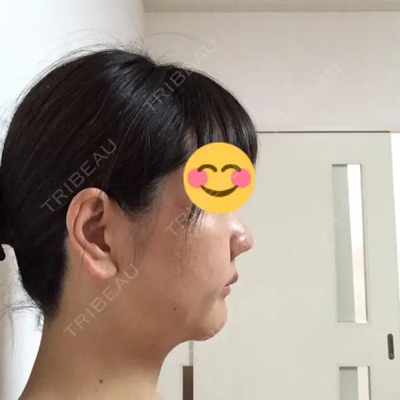鼻尖形成（切開） / 小鼻縮小（切開） / 鼻尖縮小 湘南美容クリニック 神戸院 DAY 22 メイン用