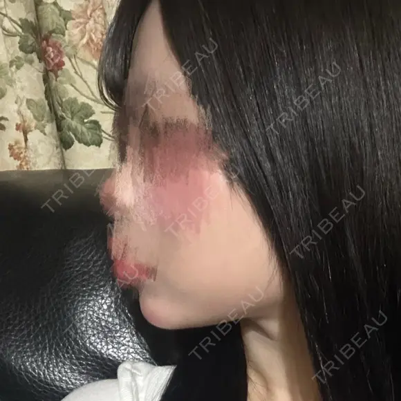 ボトックス（あご） / ヒアルロン酸注入（あご） / ボトックス（エラ・小顔） SUNMELIA SKIN CLINIC DAY 3 メイン用