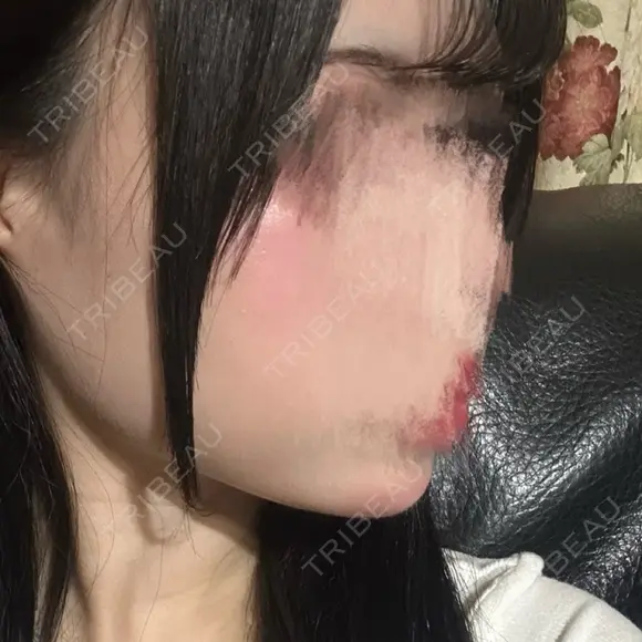ボトックス（あご） / ヒアルロン酸注入（あご） / ボトックス（エラ・小顔） SUNMELIA SKIN CLINIC DAY 3 メイン用