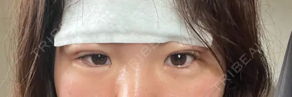 二重埋没 / ヒアルロン酸注入（涙袋） / ハイフ（顔） TCB東京中央美容外科 札幌駅前院 DAY 1 メイン用