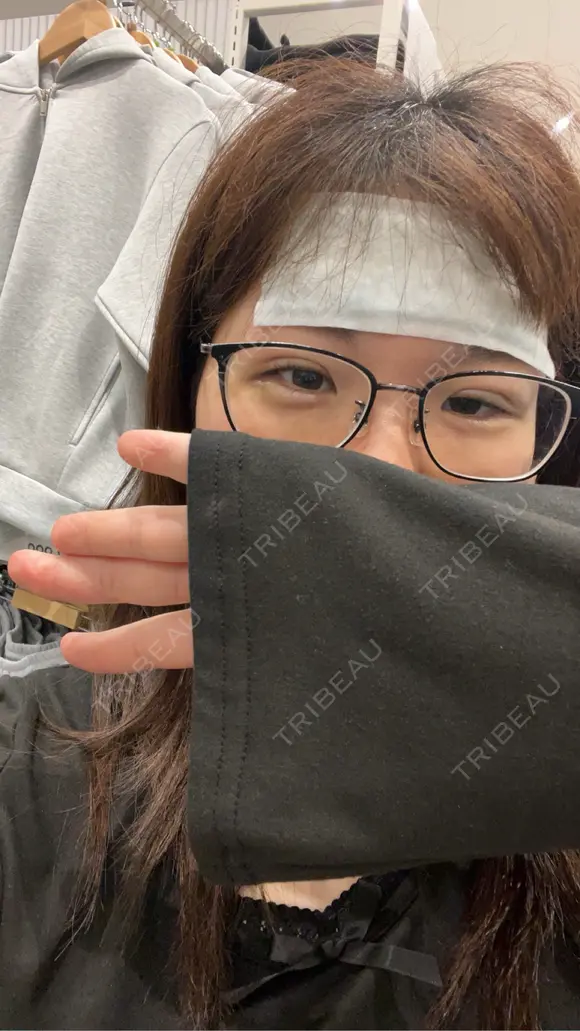 二重埋没 / ヒアルロン酸注入（涙袋） / ハイフ（顔） TCB東京中央美容外科 札幌駅前院 DAY 2 メイン用
