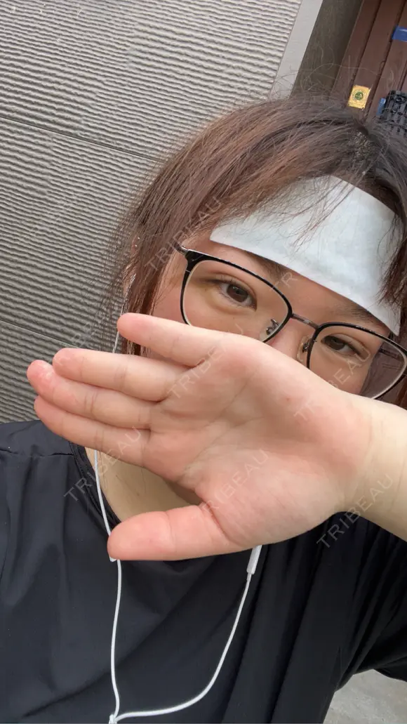 二重埋没 / ヒアルロン酸注入（涙袋） / ハイフ（顔） TCB東京中央美容外科 札幌駅前院 DAY 3 メイン用