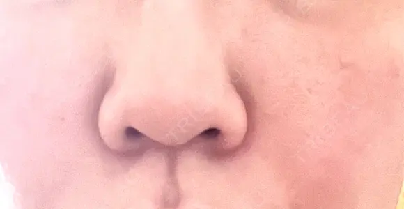 毛穴洗浄（ハイドラフェイシャルなど） まゆりなclinic 名古屋栄 DAY 8 メイン用