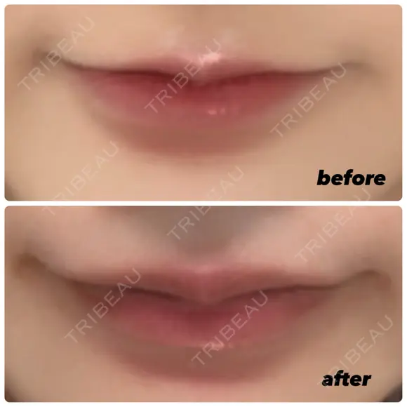 ヒアルロン酸注入（唇） / ボトックス（口角） ルラ美容クリニック 大阪心斎橋院 DAY 7 メイン用