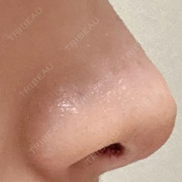 鼻尖形成（切開） / 軟骨移植 アネシス美容クリニック DAY 16 メイン用