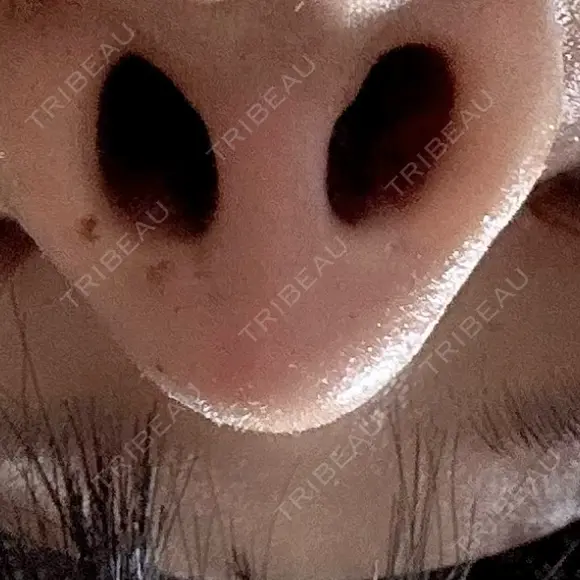 鼻尖形成（切開） / 軟骨移植 アネシス美容クリニック DAY 16 メイン用