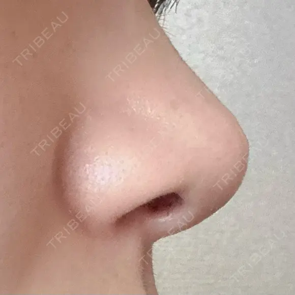 鼻尖形成（切開） / 軟骨移植 アネシス美容クリニック DAY 20 メイン用